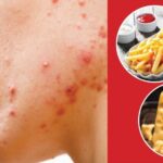 Cách điều trị mụn ở tuổi dậy thì - Những điều nên và không nên làm