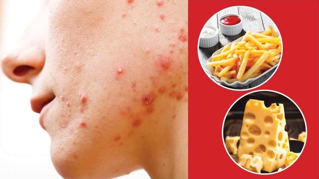 Cách điều trị mụn ở tuổi dậy thì - Những điều nên và không nên làm