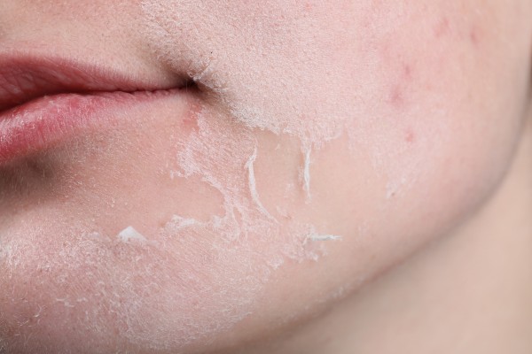 Thực hư câu chuyện trị nám bằng nhựa đu đủ xanh 2