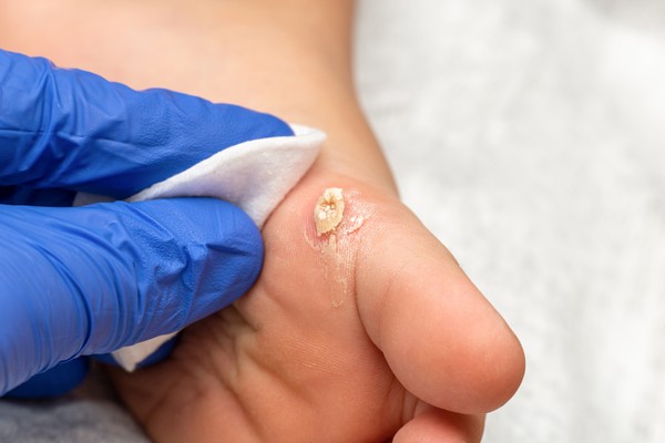 Trị mụn cóc bằng mủ đu đủ xanh có được không?