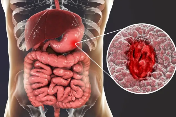 Cẩm nang sử dụng an toàn: Những ai không nên uống nước lá đu đủ? 2